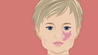 青少年胎记患者在生活中有哪些注意事项？