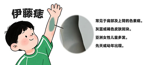<strong>伊藤痣治疗后会留疤吗？南京胎记专科医院哪家好？</strong>